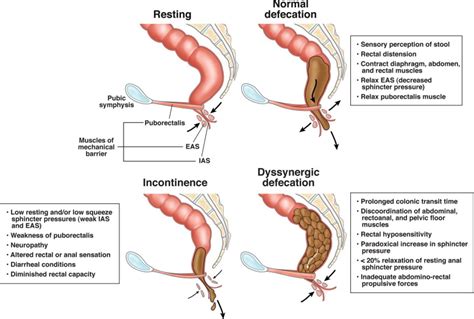 advances in diagnostic assessment of fecal incontinence and dyssynergic defecation clinical