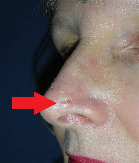 Nose Cancer Cheaper Than Retail Price Buy Clothing Accessories And