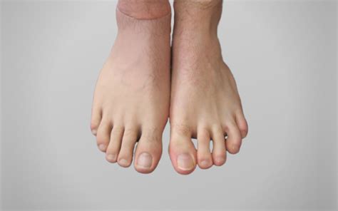 Partial Foot Amputation Atlantic Prosthetic Orthotic Services Ltd