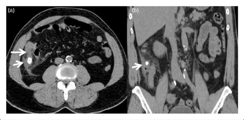 Non Contrast Preoperative Ct Abdomen Axial A And Coronal B Images