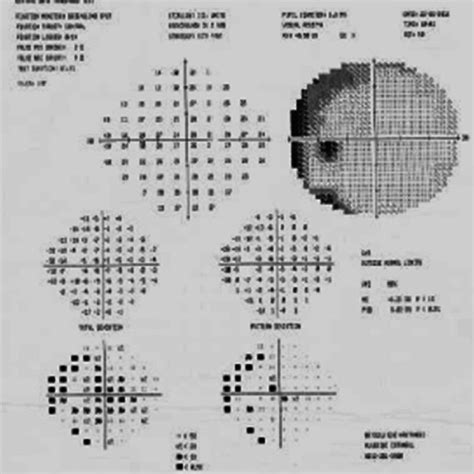 ­enlargement Of The Blind Spot On Visual Field Download Scientific