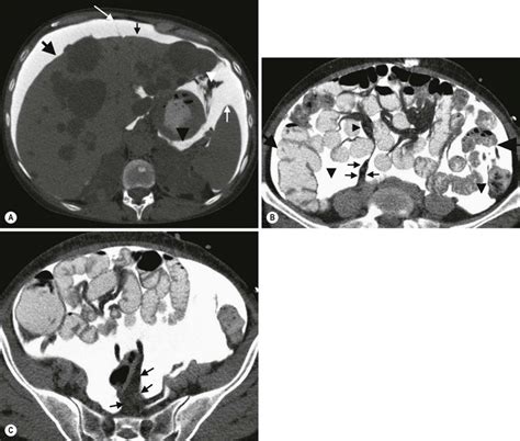 2:21course of the peritoneum 4:14lesser omentum. Imaging of The Peritoneum, Mesentery and Omentum ...