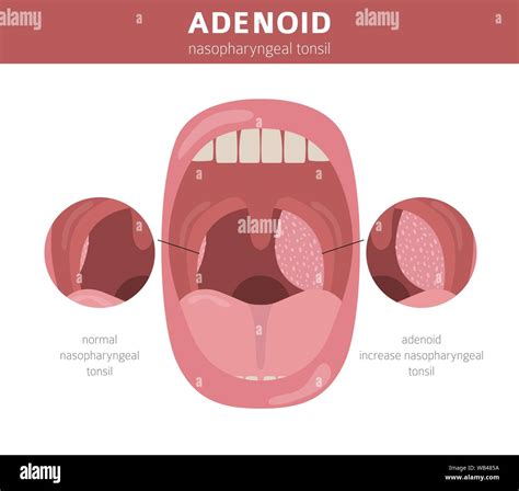 Adenoid Nose