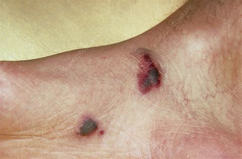 Kaposi S Sarcoma On The Foot Of An Aids Patient Stock Image M