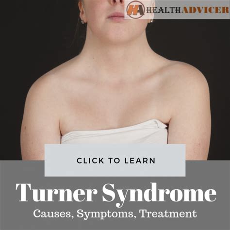 Turner Syndrome Causes Picture Symptoms And Treatment