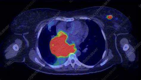 Diffuse Large B Cell Lymphoma Ct And Pet Scan Stock Image C055
