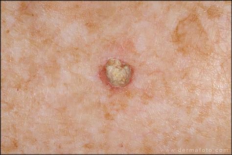 Actinic Keratosis Potentially Cancerous These Spots Feel Rough And