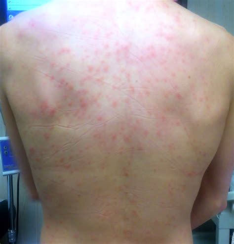 How Acupuncture Treats Skin Hives Tao Of Medicine
