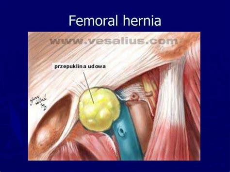 Ppt Hernia Powerpoint Presentation Free Download Id2306551
