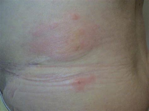 Parasitoses Bites Insect Bites Picture Hellenic Dermatological