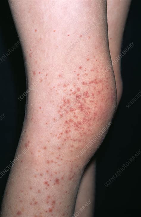 Purpura Rash Stock Image M2400453 Science Photo Library