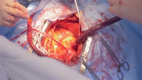 Real Heart Beats Through Open Chest During Surgery 4k