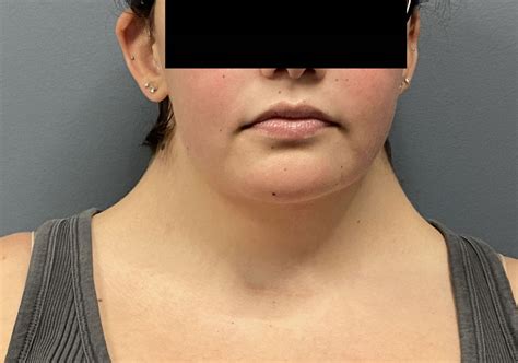 Plastic Surgery Case Study Webbed Neck Correction With Buffalo Hump