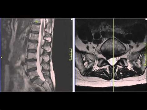 Lumbar Disc Herniation Mri Explained Lumbar Herniated Disc Youtube
