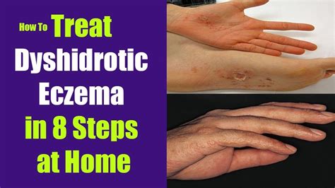 How To Treat Dyshidrotic Eczema In 8 Steps At Home Youtube