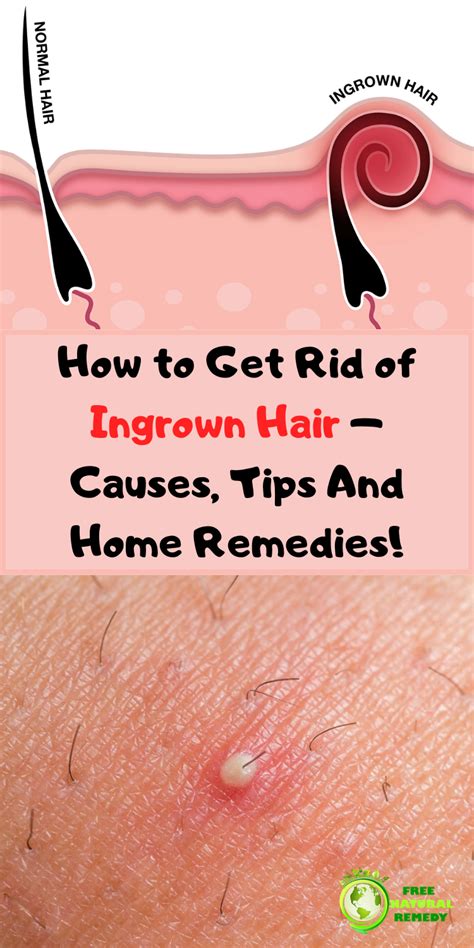 Quickest Way To Remove Ingrown Hairs Howotre