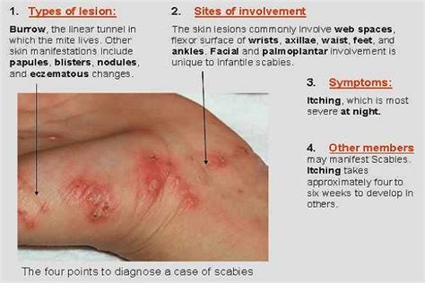 14 Effective Home Remedies Against Scabies Health And Wellness