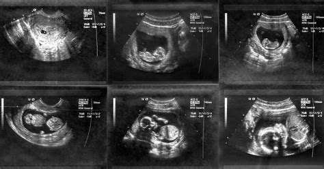 Week By Week Pregnancy Scan Photos Weeks 4 40 Netmums