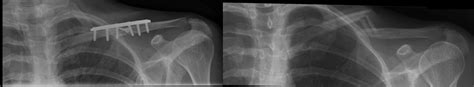 Evaluation And Management Of Clavicle Fractures Midshaft Lateral And