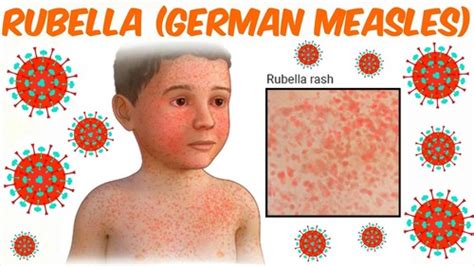 Children S Infectious Rash Disease Rubella Varicella Measles 5th