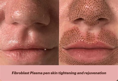 Laser Skin Treatment Face Treatment Botox Skin Tightening Treatments