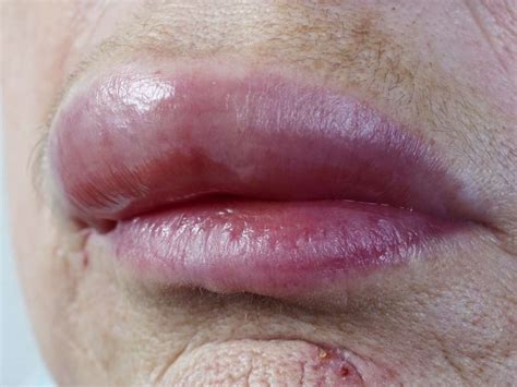 Actinic Cheilitis Causes Treatment And Prevention