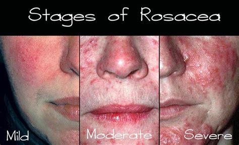 Study Medical Photos A Brief Description Of Acne Rosacea