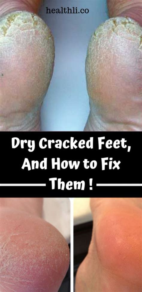 Dry Cracked Feet And How To Fix Them Dry Cracked Feet Health Fix It