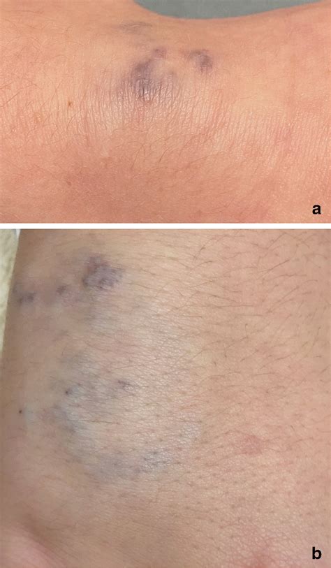 Venous Malformation A Clinical Image Shows Blue Skin Discoloration Of