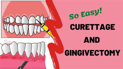 Gingival Curettage And Gingivectomy Periodontology Youtube