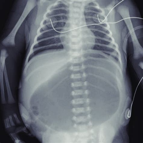 The Finding Of Ultrasonography In Gastric Outlet Obstruction A