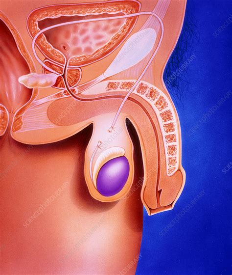 We did not find results for: Artwork showing a vasectomy operation - Stock Image - M860/0079 - Science Photo Library