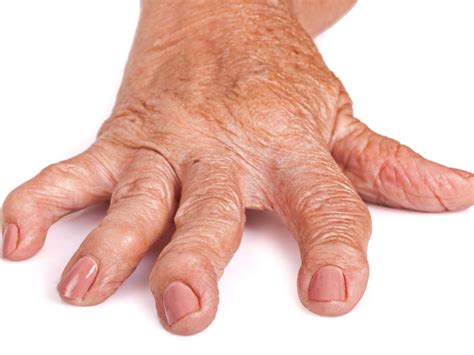 Rheumatoid Arthritis Pictures Symptoms In The Joints