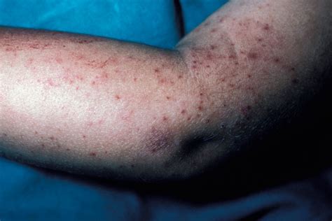 Derm Dx Boy With Nausea Vomiting And Fatigue Develops A Red Blotchy