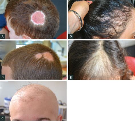 Traction Alopecia Causes Treatment And Prevention Atelier Yuwaciaojp