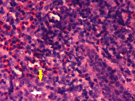 Eosinophilic Granuloma Of The Mandible A Diagnostic Dilemma Bmj Case