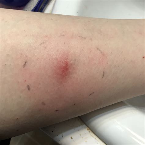 Day 2 May 27 2017 Spider Bites