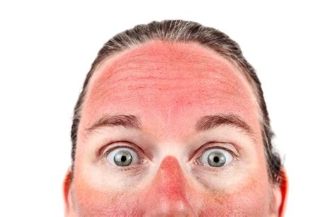 Treating A Burning Skin On Face With Rash Itchy Or Red