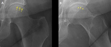 Osteonecrosis Of The Femoral Head With Subchondral Collapse Cleveland