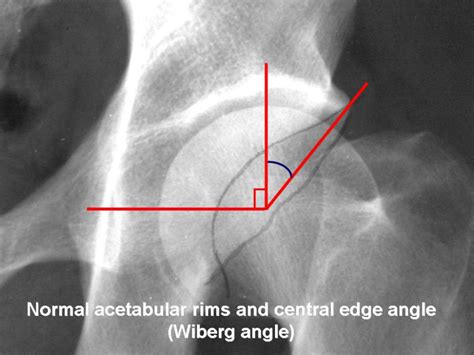 Normal Acetabular Rims And Wiberg Angle Radiology Case Radiopaedia
