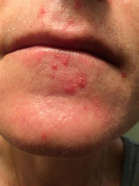 Acne Why Am I Constantly Dealing With These Small Clogged Pores