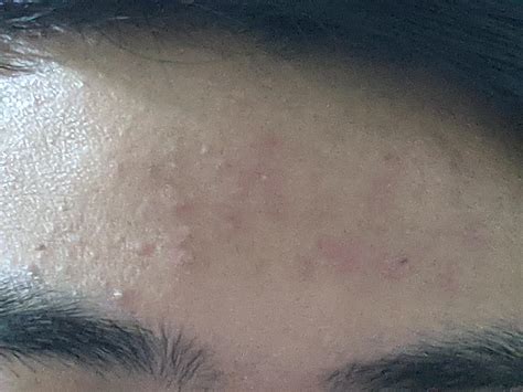 Got These Small Red Bumps Growing On My Forehead One Day Painless As