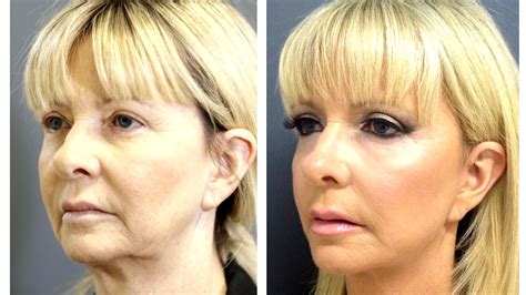 Lower Mini Face Lift Lift Choices