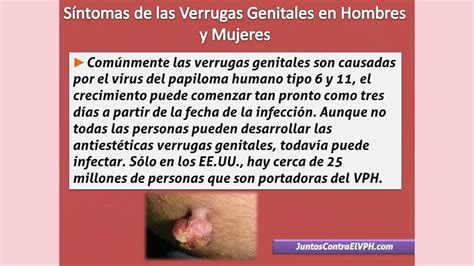 Síntomas de las Verrugas Genitales Hombres y Mujeres Papiloma Humano VPH YouTube