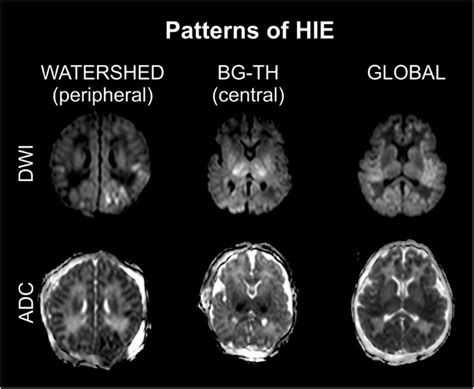 Hie Brain Imaging Birth Injury Law Firm