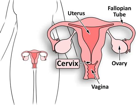 Cervical Cancer Symptoms And Treatment Cervical Cancer Esmo Clinical