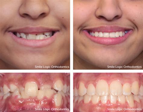 Braces Before And After Crowding