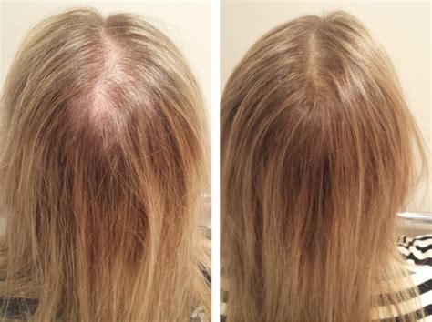 5 Ways To Hide Thinning Hair Sis Hair