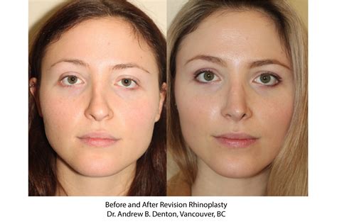 Before And After Revision Rhinoplasty Dr Denton