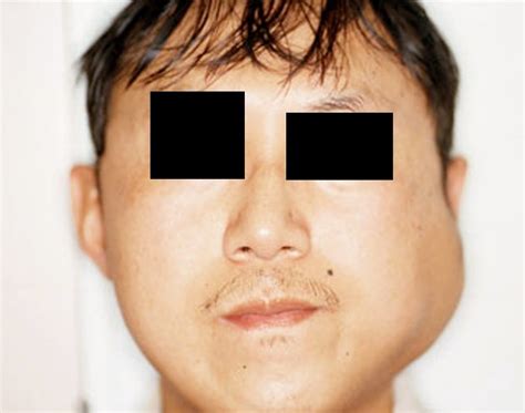 Parotid Gland Swelling Symptoms Pictures Causes Treatment 2018